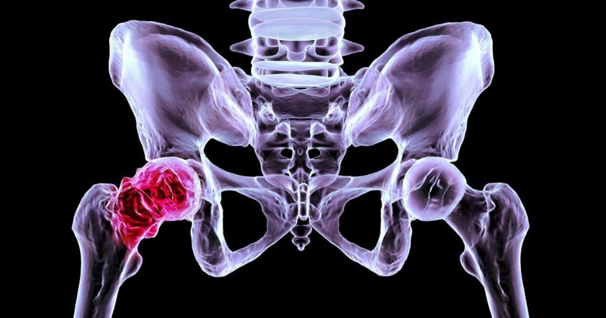 Descubren por qué en la artrosis se destruye el cartílago y cómo regenerarlo